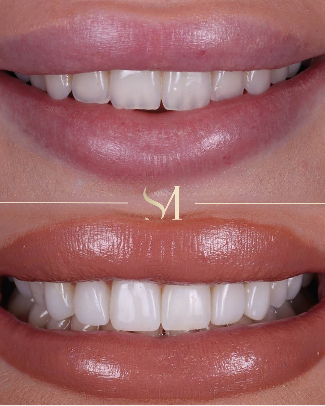 Composite bonding result