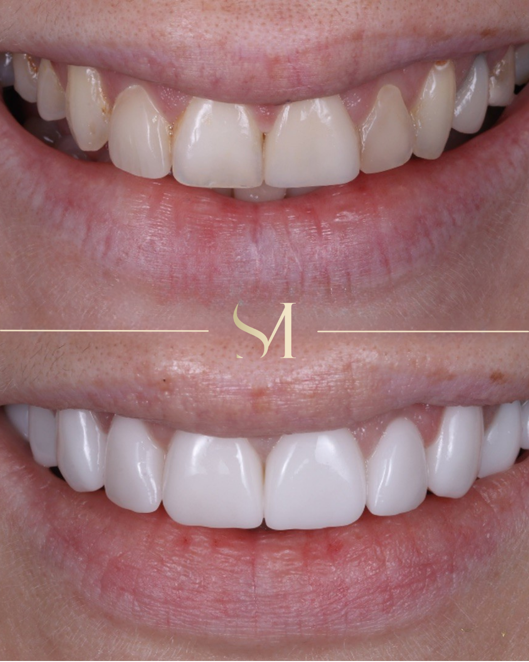 Veneers result