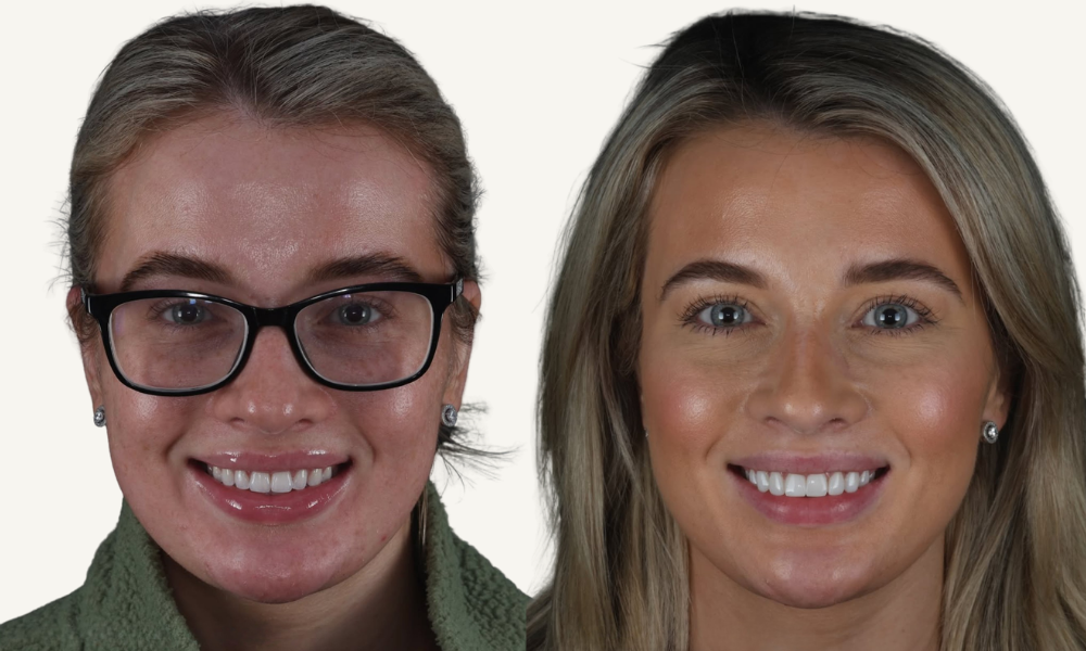 Before and after composite veneers treatment