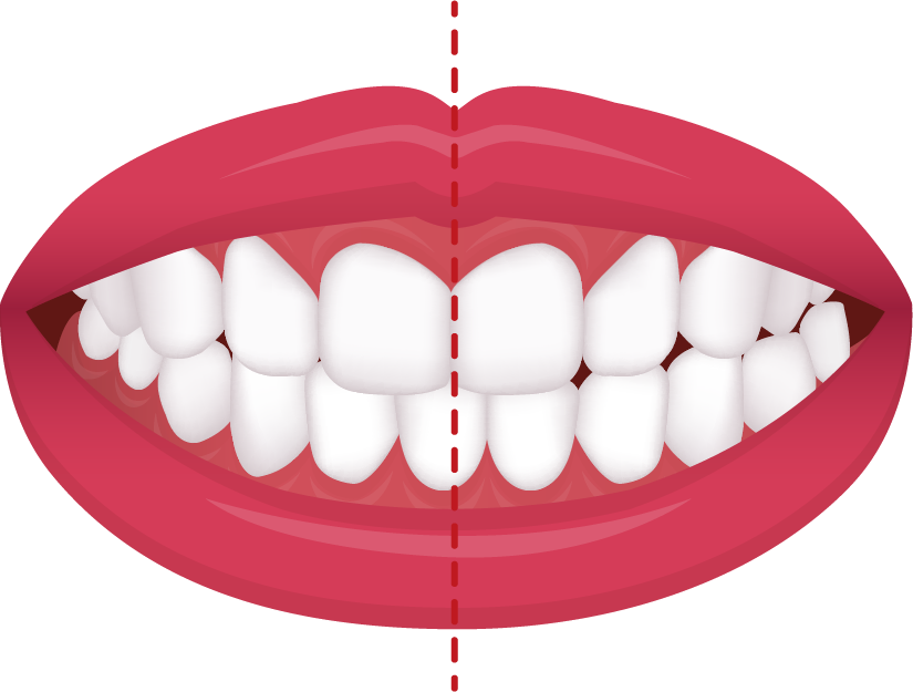 Crossbite illustration