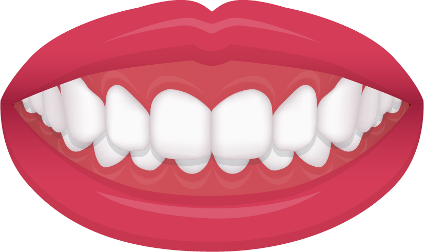 Deep bite illustration