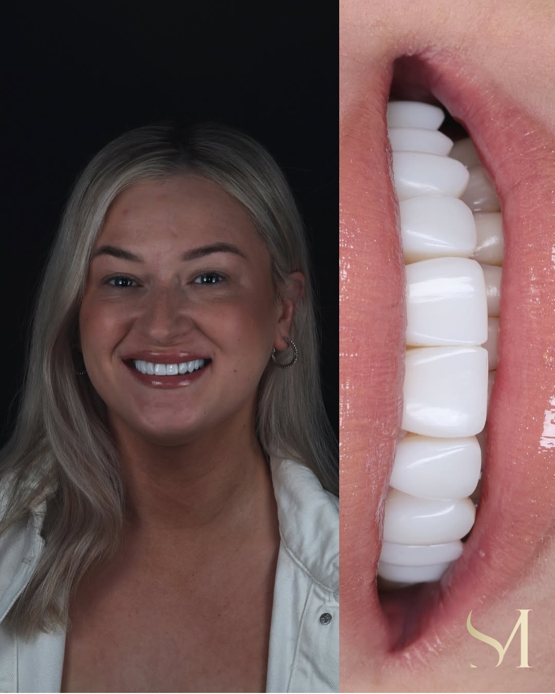 Smile makeover: Invisalign, whitening and composite veneers