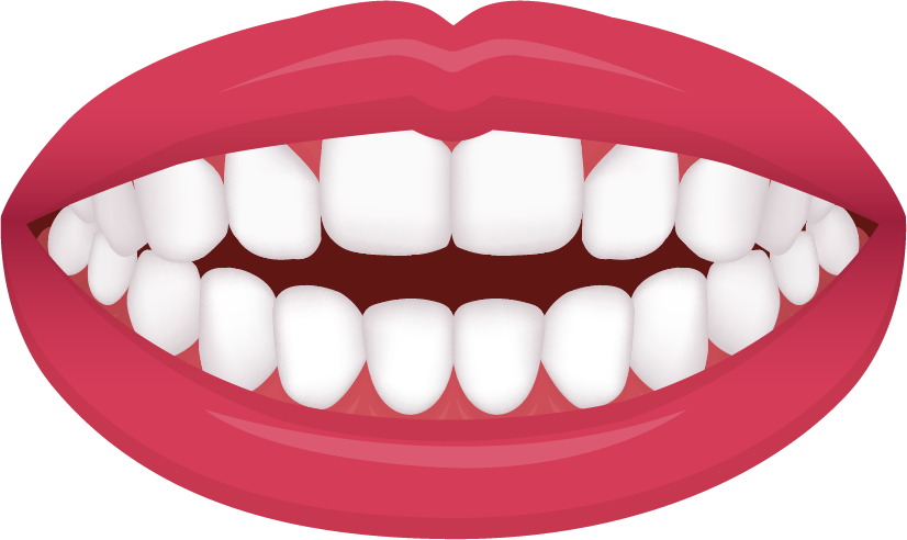 Open bite illustration