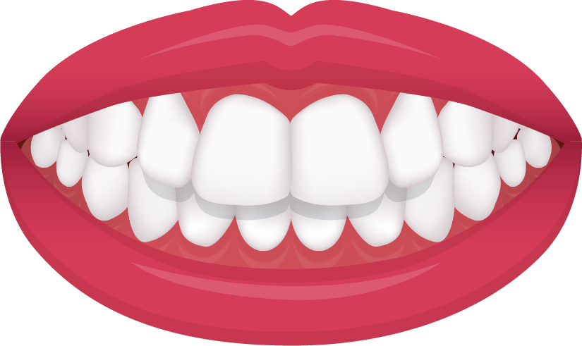 Overbite illustration