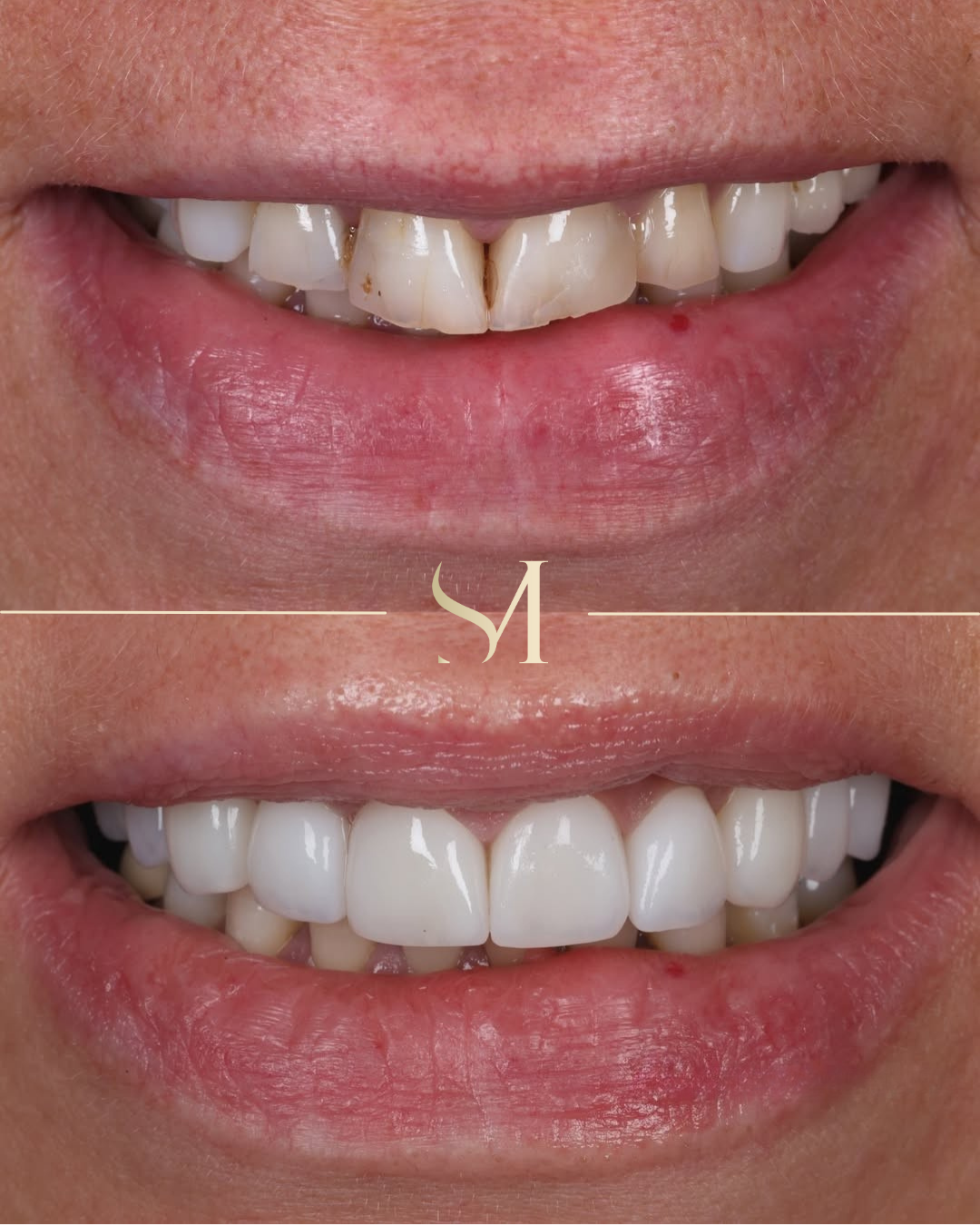 Porcelain veneers result