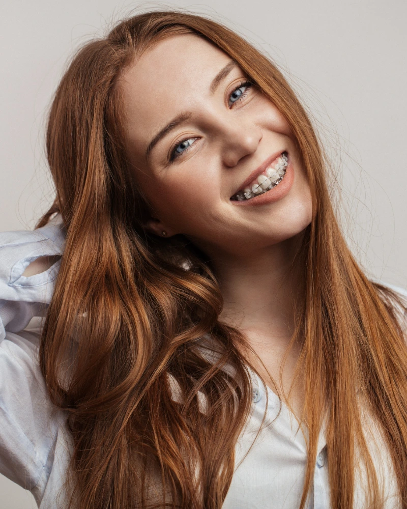 Six Month Smiles braces