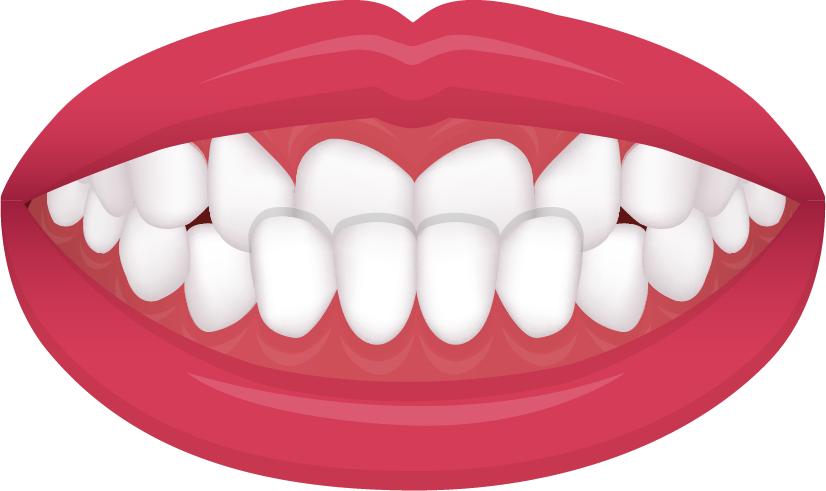 Underbite illustration