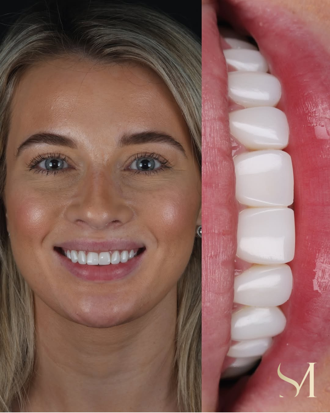 Smile makeover: whitening and composite veneers